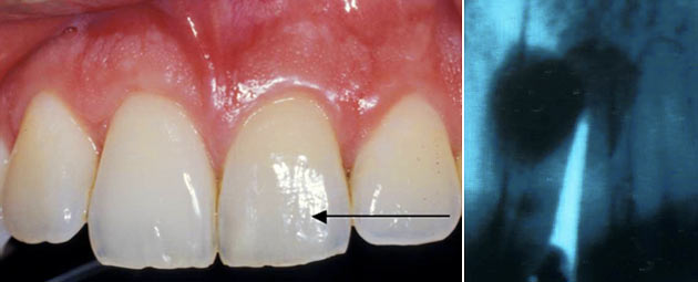 Von uns mittels spezieller Schnittführung resezierter Zahn 21 ohne sichtbare Narben