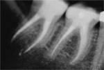 Moderner Zahnerhalt - Endodontie