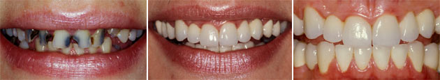25-jährige Phobiepatientin; sämtliche Zähne mit Vollkeramikkronen versorgt